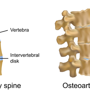 osteoarthritic spine